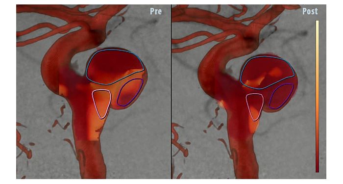 Технология Philips AneurysmFlow
