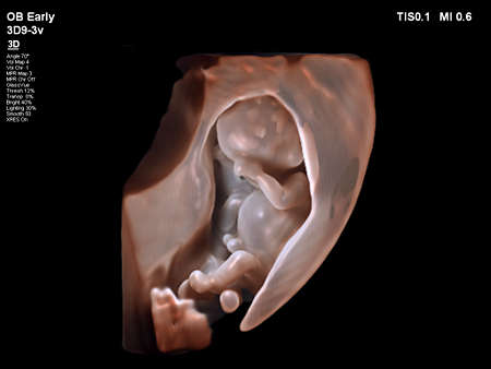 3D9-3v Fetal Imaging with TrueVue