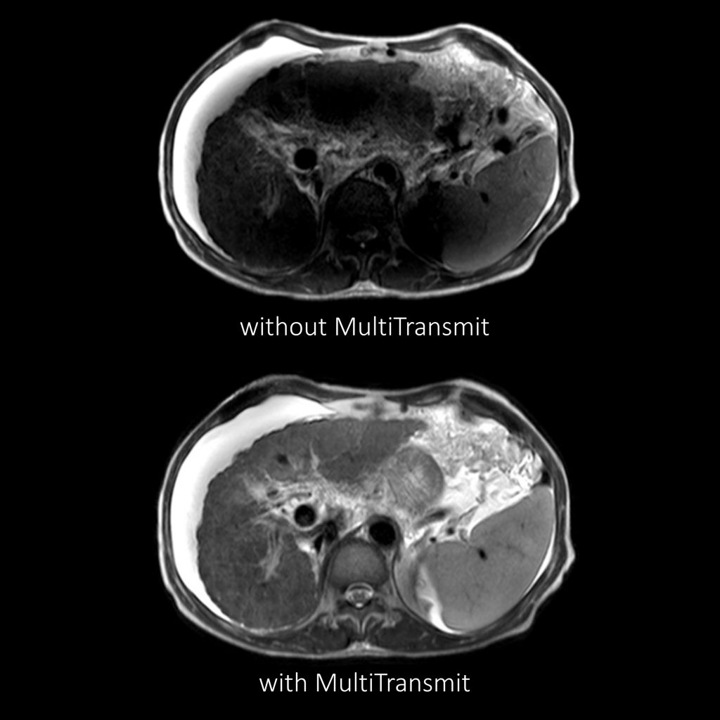 4D MultiTransmit RF technology for 3T MRI scanners