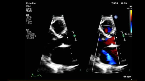 Affiniti CVx X5-1 PLAX Mitral Regurgitation