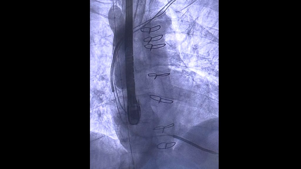 Fluoroscopy of Bridge Plus –Image on file with Philips
