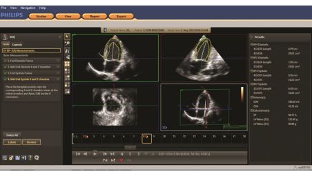 Cardiac 3D Quantification (3DQ)