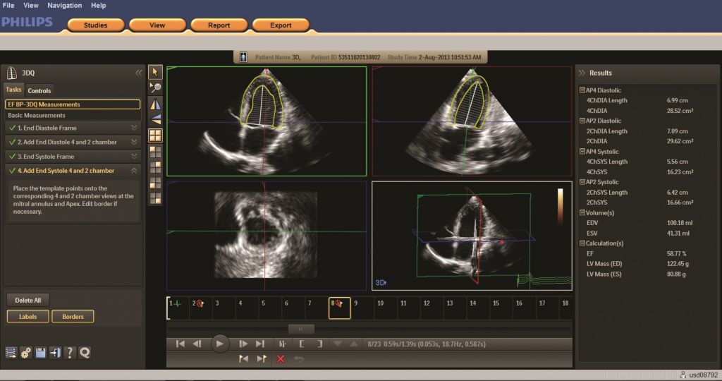Cardiac 3D Quantification (3DQ)