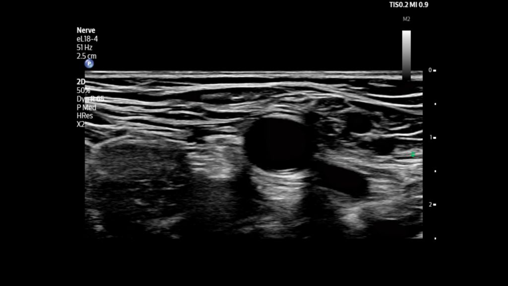 Femoral artery and nerve shown using eL18-4 transducer on Flash 5100 POC.