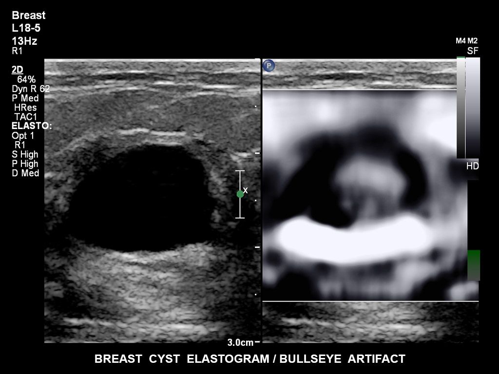 Breast cyst elastogram