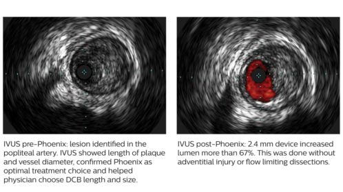 Phoenix created 67% luminal gain without vessel injury ³,⁵,⁷