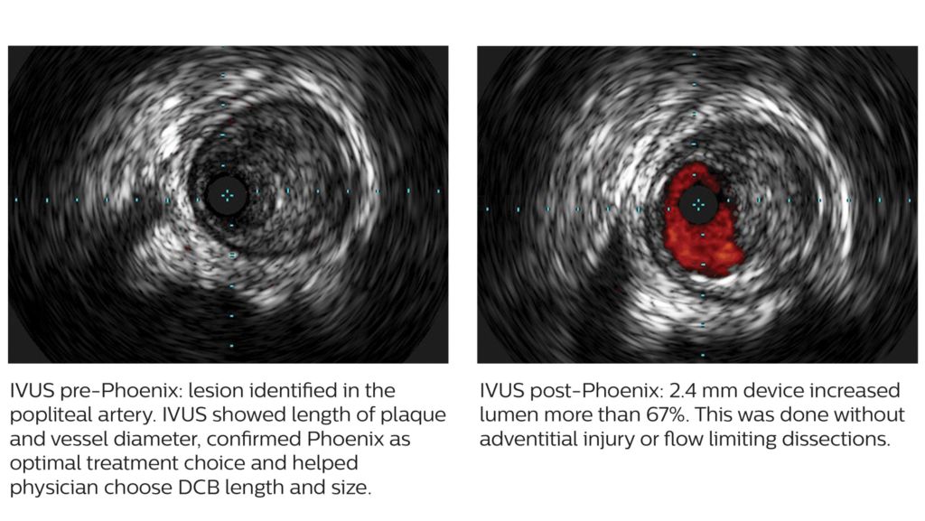 Phoenix created 67% luminal gain without vessel injury ³,⁵,⁷