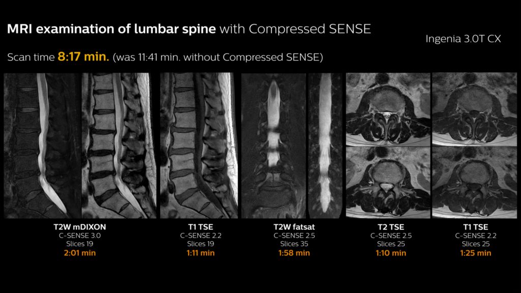 Lumbar spine MRI with Compressed SENSE