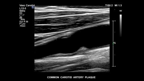 Common carotid artery plaque