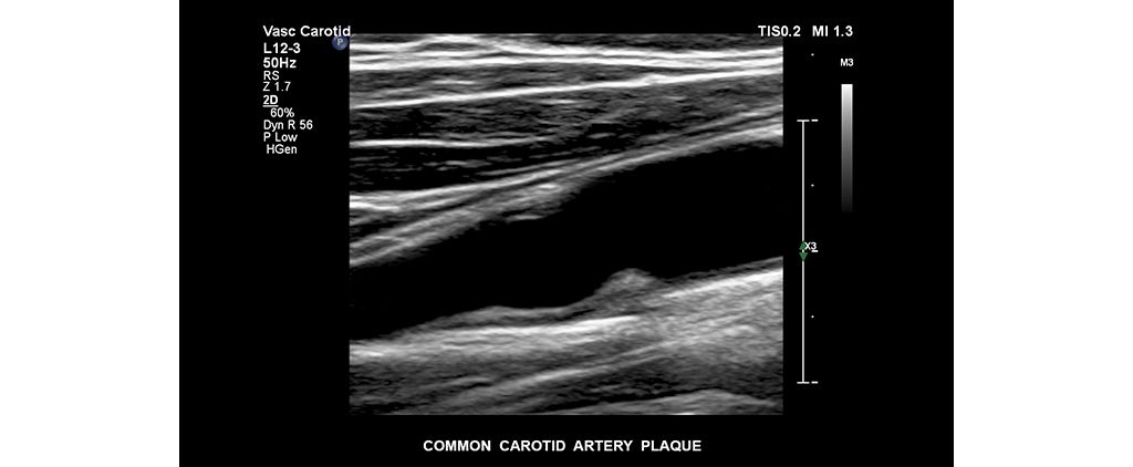 Common carotid artery plaque