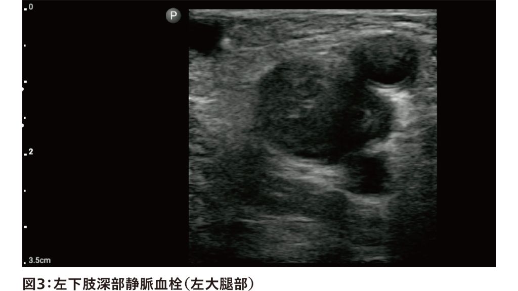 図3：左下肢深部静脈血栓（左大腿部）