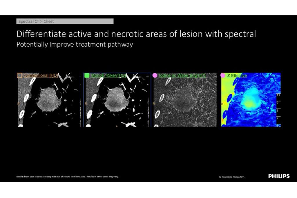 Spectral CT – Chest