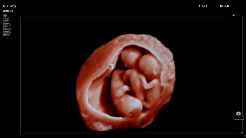 Triplets shown using TrueVue on 3D9-3v transducer