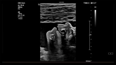 HD Max Monitor for EPIQ Elite and MaxVue High Definition Ultrasound Display Format Demonstration with Dr. Michael Ruma  