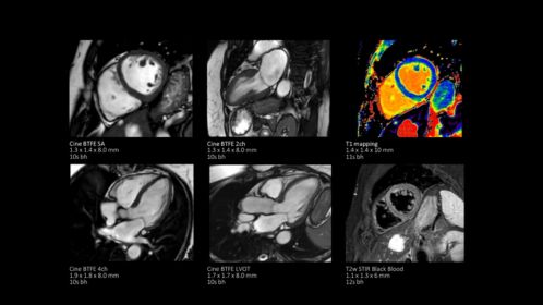 Non-contrast cardiac on MR 5300 with SmartSpeed
