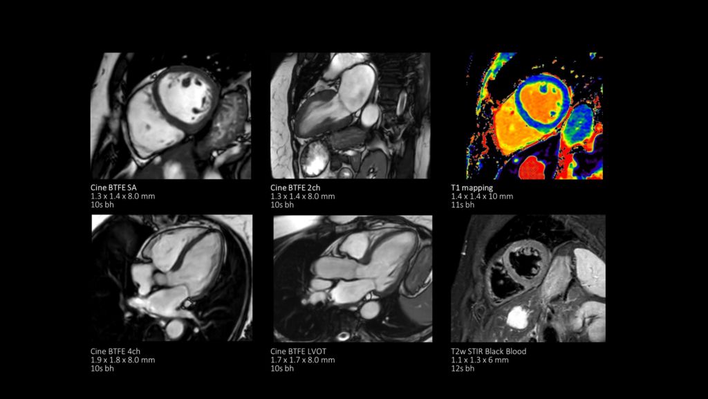 Non-contrast cardiac on MR 5300 with SmartSpeed