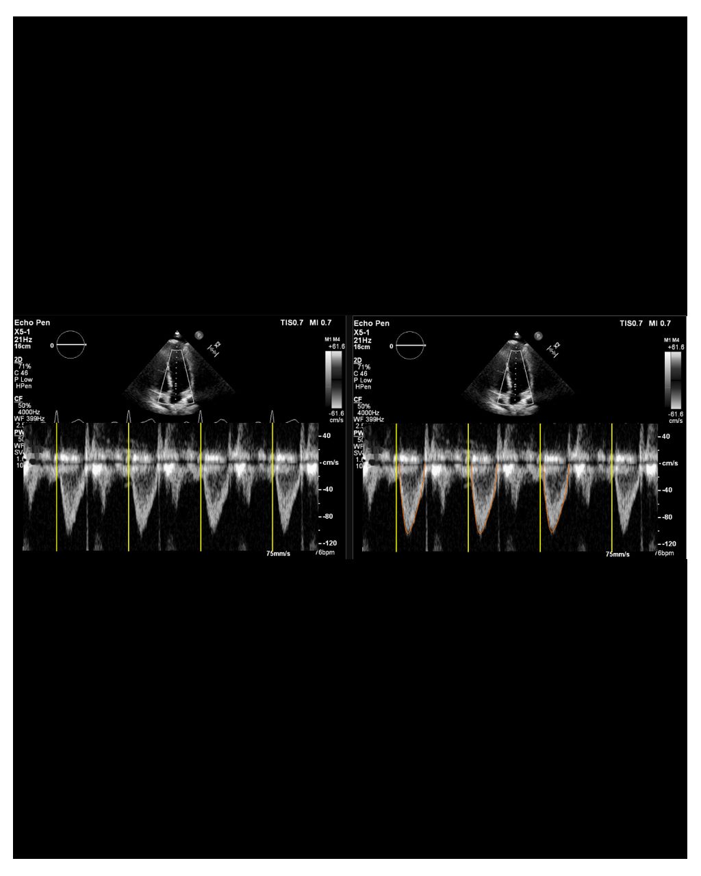 AI-powered Auto Measure delivers fast and consistent Doppler and 2D measurements