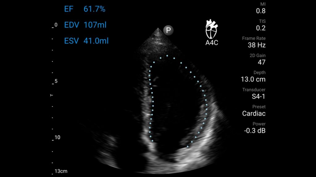 Apical four chamber view of the heart with Auto EF tool shown using S4-1 transducer on Lumify.