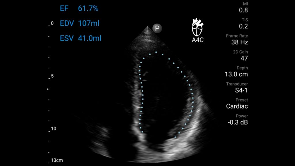 Apical four chamber view of the heart with Auto EF tool shown using S4-1 transducer.