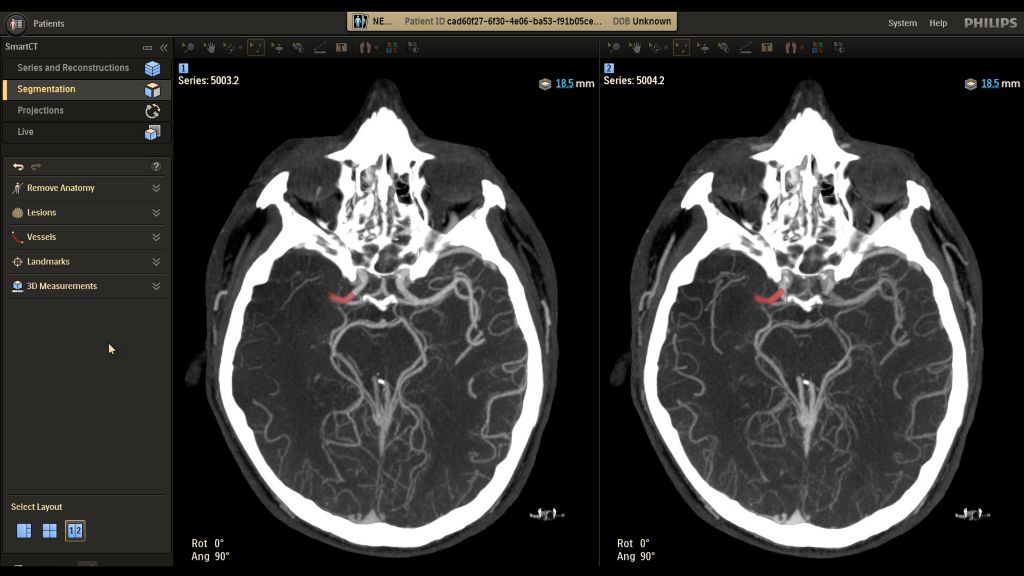 SmartCT Dual Phase Cerebral
