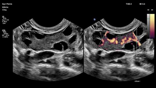 Ovaries in MaxVue display using 3D9-3v transducer