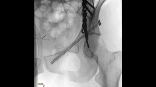 Clinical Image Philips Veradius Unity Mobile C-arm with Flat Detector