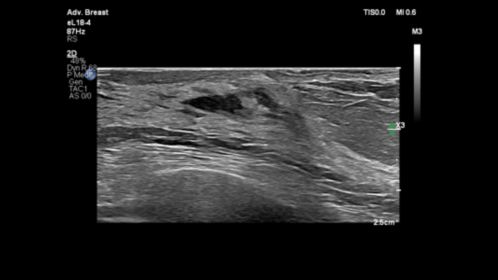 eL18-4 for Breast