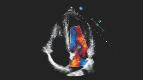 Cardiac apical four chamber view with mitral inflow