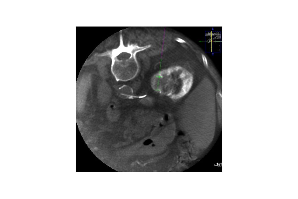 Lung Microwave Pre-treatment XperCT with XperGuide ablation plan (lateral).