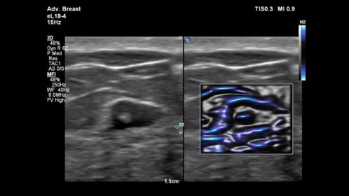 Breast clip with MFI comparison on eL18-4 transducer