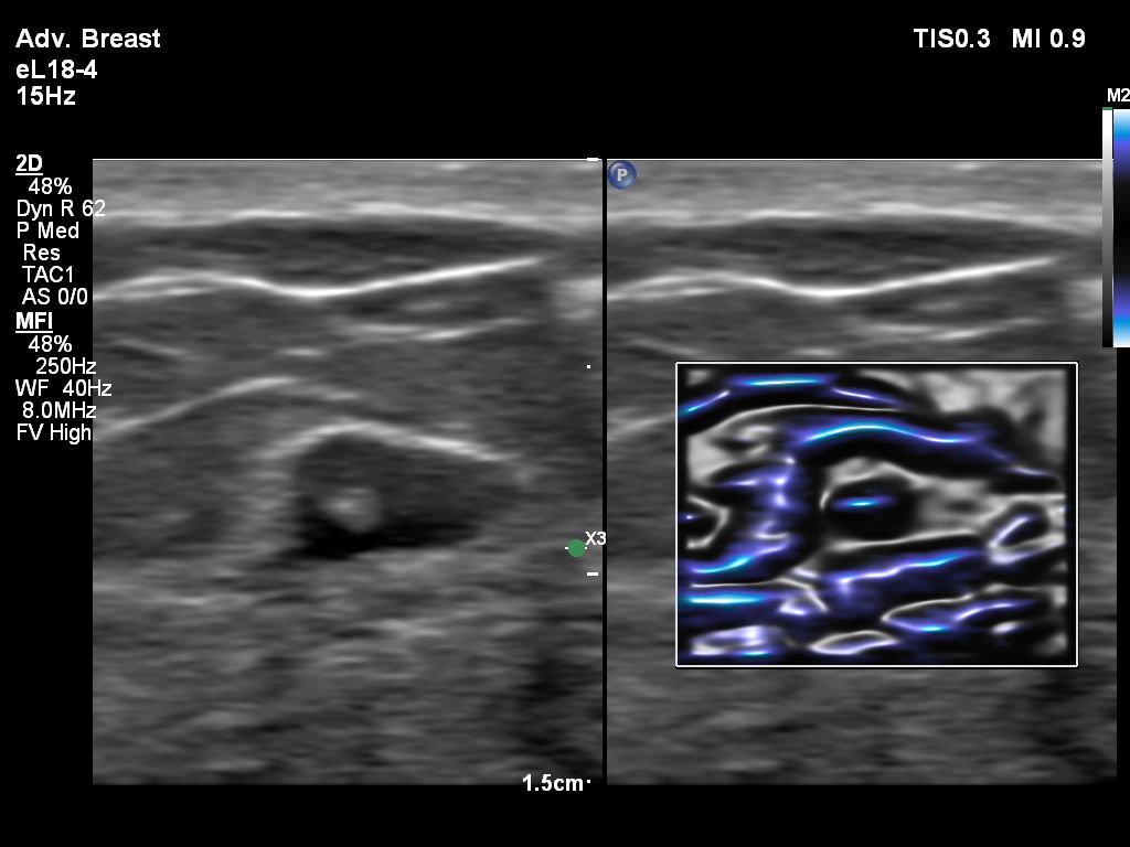 Breast clip with MFI comparison on eL18-4 transducer