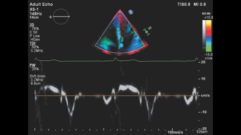 Affiniti CVx X5-1 Tissue Doppler