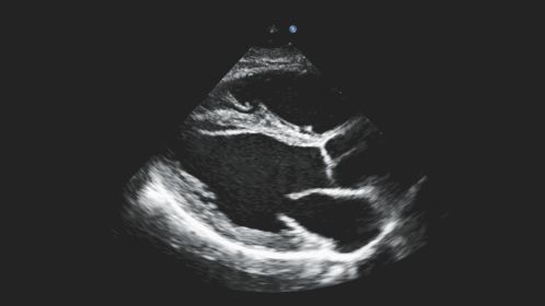 Cardiac plax view