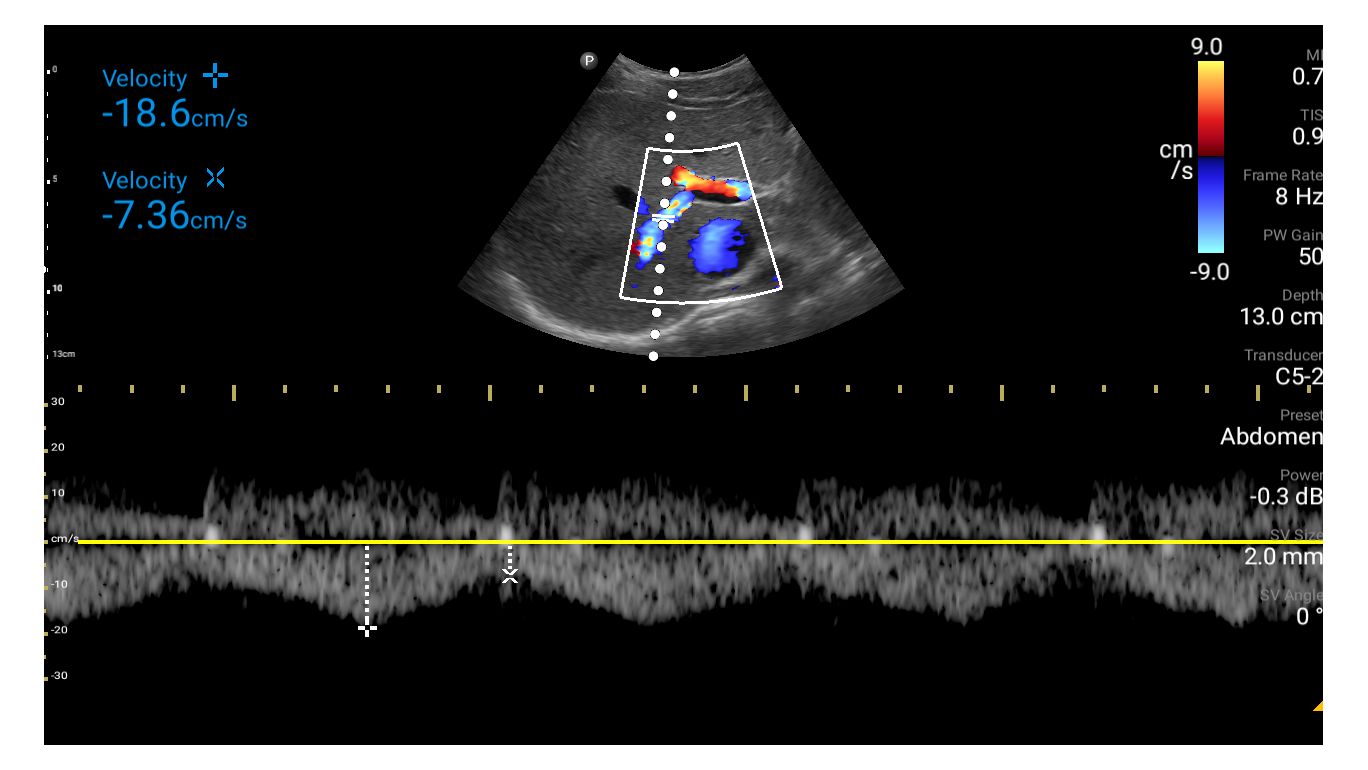 Portal vein with color and Pulsed Wave Doppler shown using C5-2 transducer.