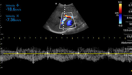 Portal vein with color and Pulsed Wave Doppler shown using C5-2 transducer.