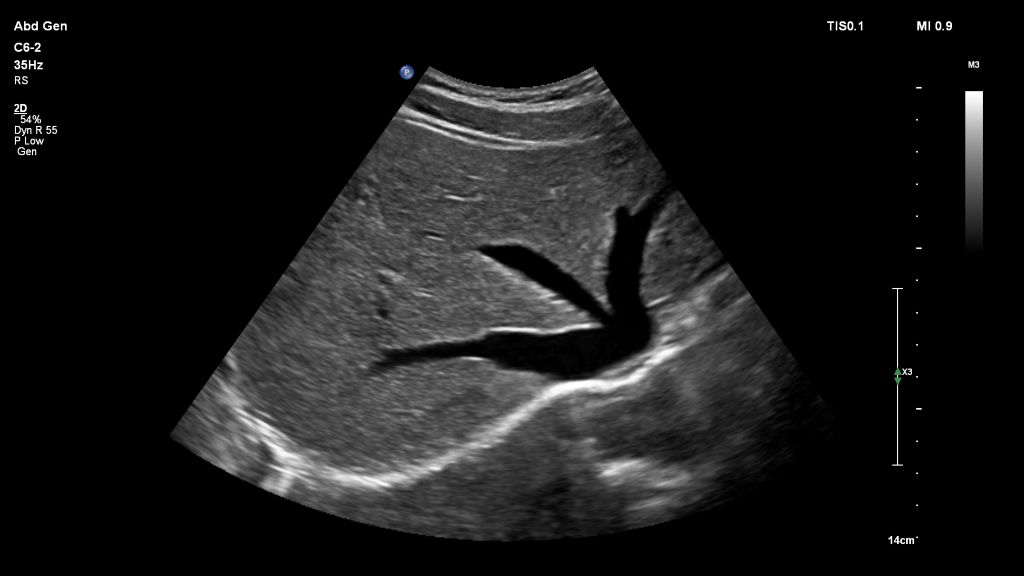 Liver and Hepatic Veins in 2D using C6-2 transducer
