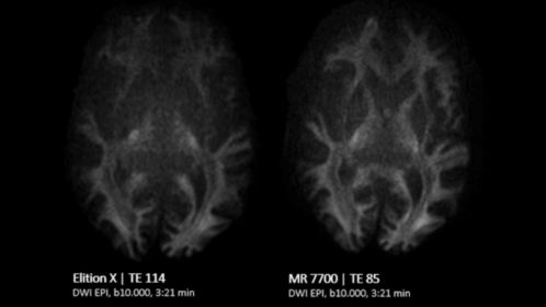 Brain Comparison DWI EPI b10.000