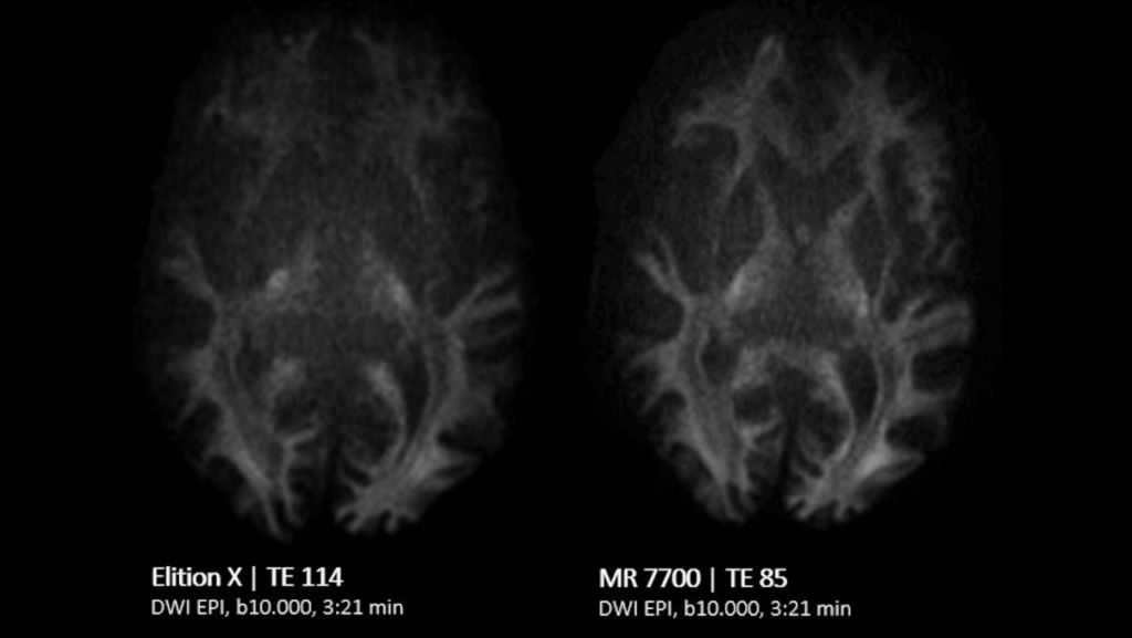 Brain Comparison DWI EPI b10.000