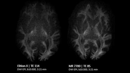 Brain Comparison DWI EPI b10.000