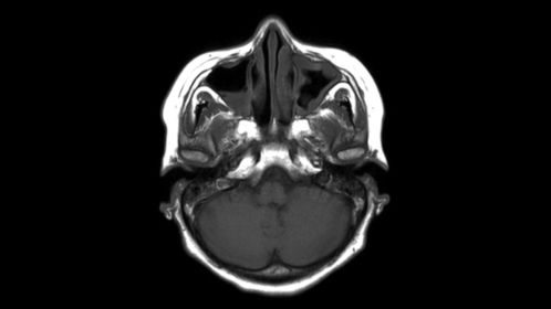 mDIXON XD TSE Brain MR Clinical application | Philips