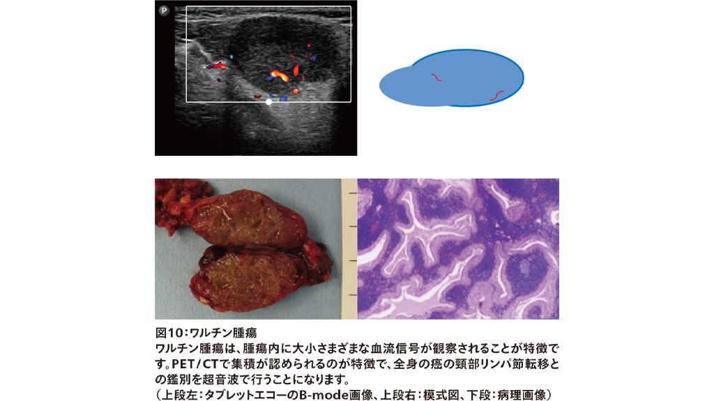 図10：ワルチン腫瘍