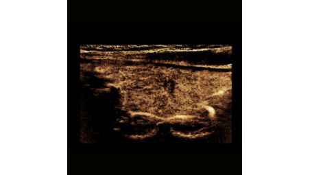 Contrast-enhanced ultrasound (CEUS)