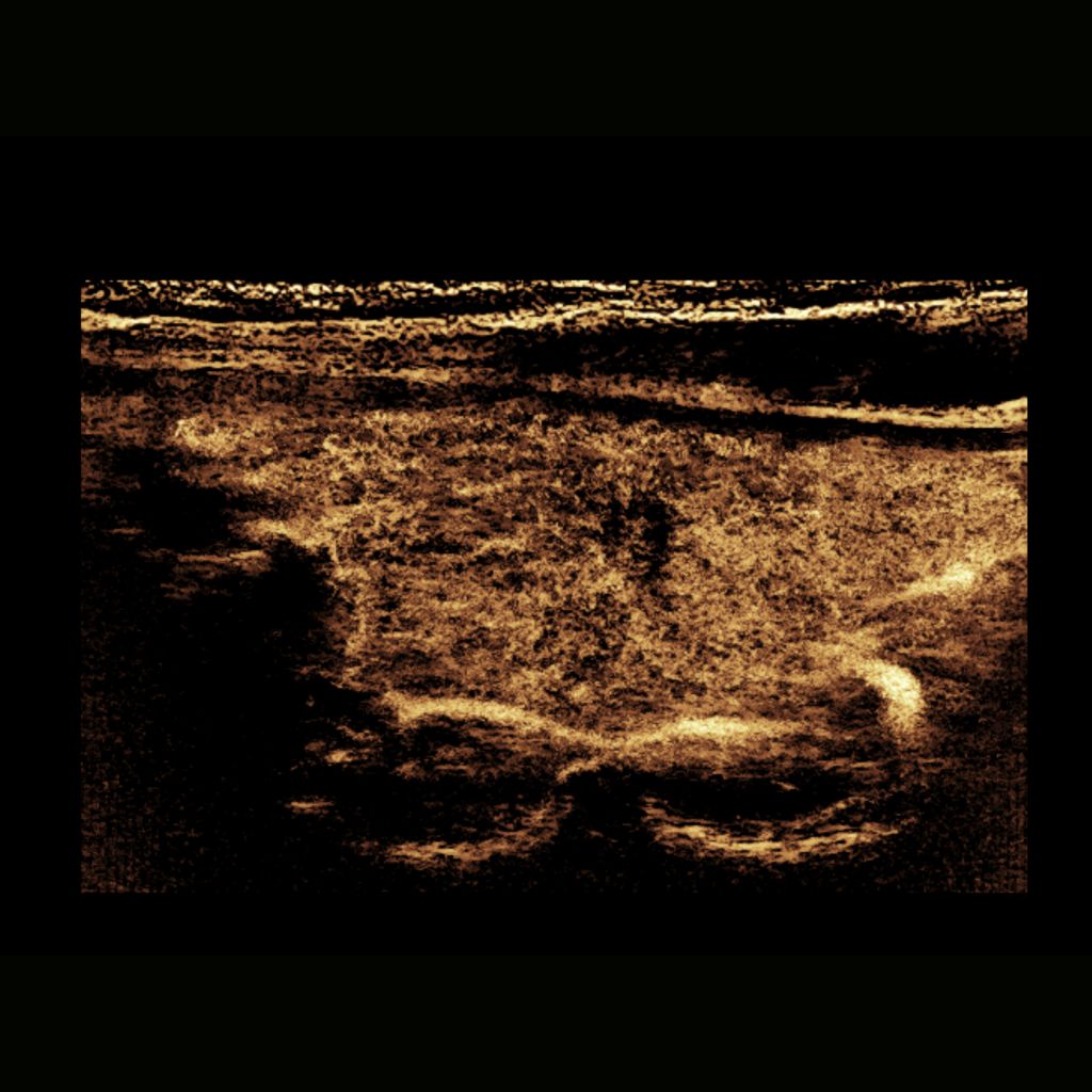 Contrast-enhanced ultrasound (CEUS)