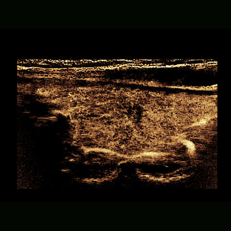 Contrast-enhanced ultrasound (CEUS)