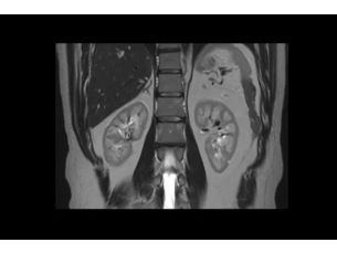 SmartSpeed Precise - Abdomen MR Clinical Applications