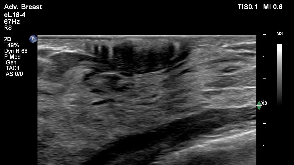 eL18-4 with 2D Imaging