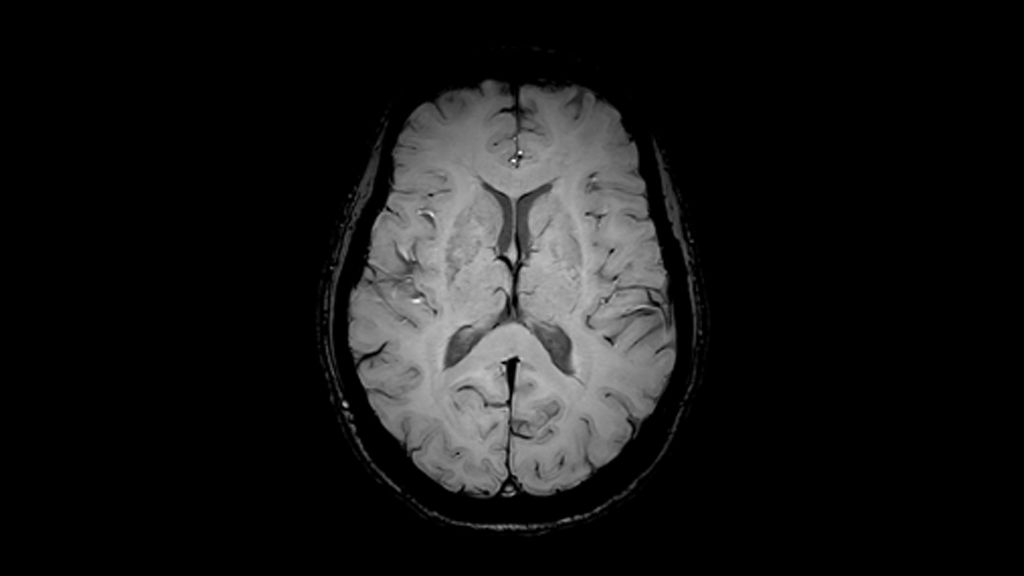 3D SWI clinical image of the brain