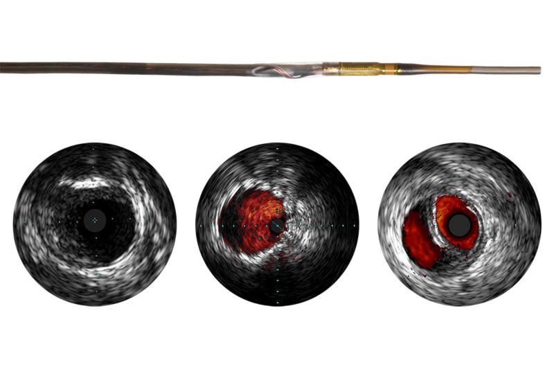 Visions PV .018 RX — Digital IVUS Catheter