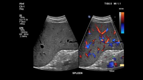 EPIQ ultrasound machine clinical image of a spleen 