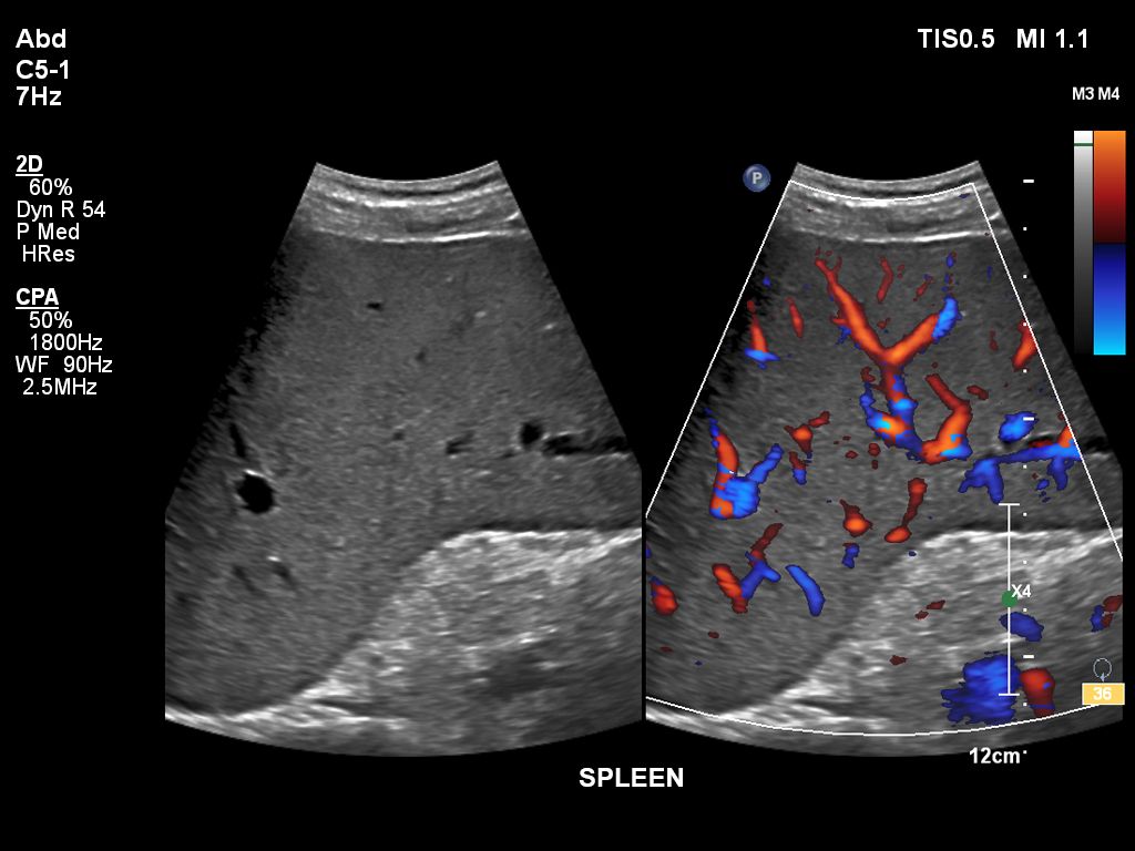 EPIQ ultrasound machine clinical image of a spleen 